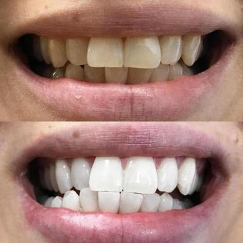 Teeth before and after using WHYTE whitening strips
