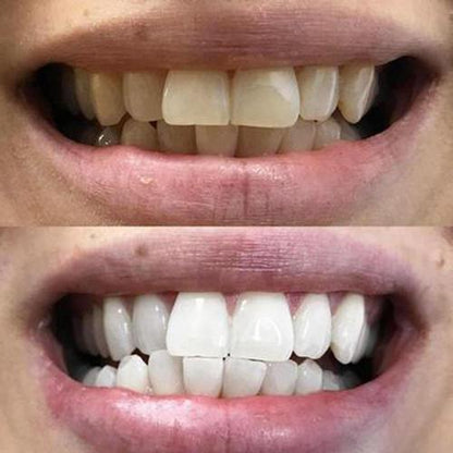 WHYTE™ Teeth Whitening Strips - 14 Strips